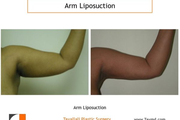 liposuction surgery arms before after front view