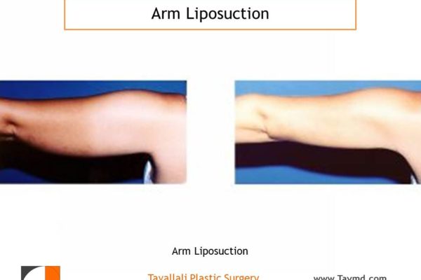back view Arm liposuction surgery result