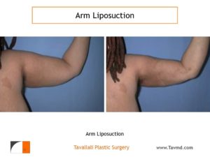 Arm liposuction surgery result after 2 weeks