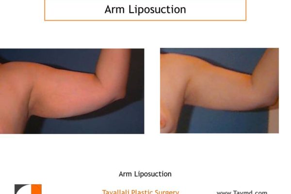 Arm liposuction surgery result before and after