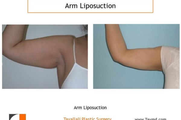 Arm liposuction surgery result Virginia