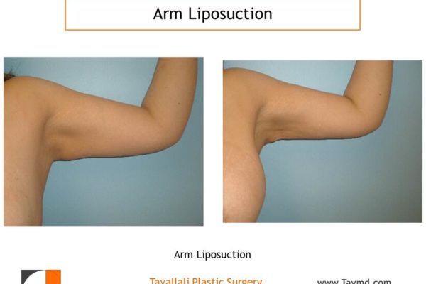 Arm liposuction surgery result
