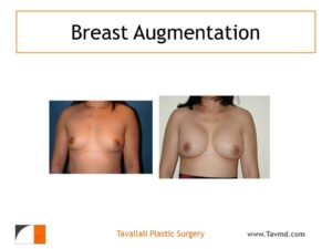 Before & after breast augmentation surgery