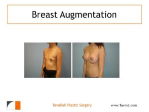 Oblique view Breast enlargement with saline implants