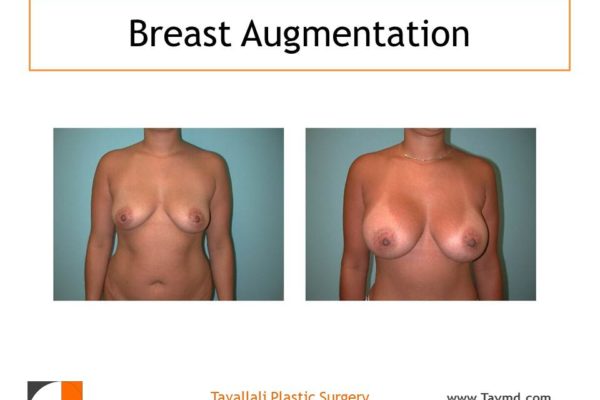 Result of woman with large breast enlargement