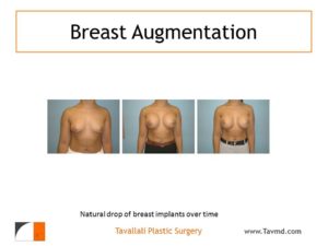 Stages of breast implants falling