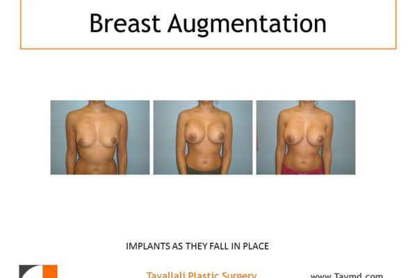 Breast implants falling into position over 4 months