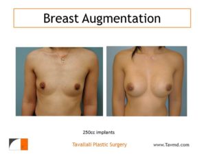 Before after breast augmentation surgery
