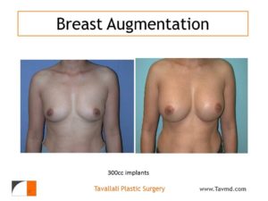 Breast enlargement with silicone implants
