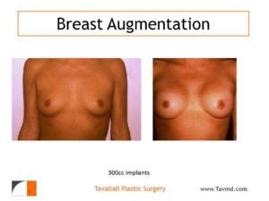 Silicone implants in breasts