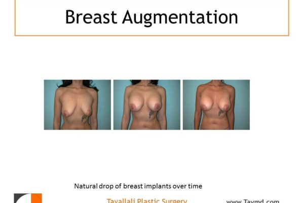 Early and late results of breast implants