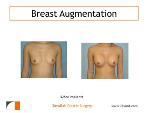 Saline implants in breasts