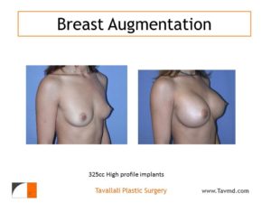 325 cc saline breast implants before and after