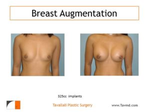325 cc saline breast implant augmentation before and after