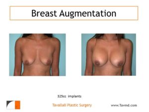 325 cc saline breast implant enlargement before and after