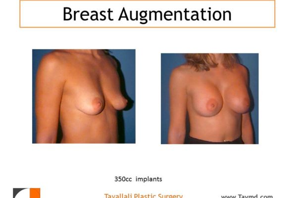 Breast augmentation with 350 cc implants before after