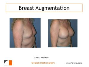 350 cc breast implants before after