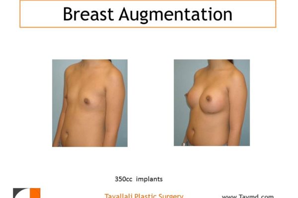 Breast augmentation with 350 cc saline implants in woman with flat chest