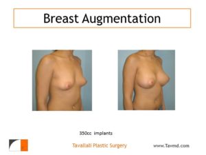 Breast enlargement with 350 cc implants