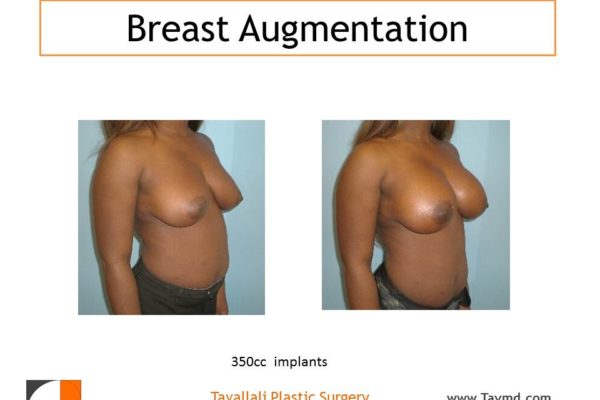 Breast enlargement in woman with saline 350cc