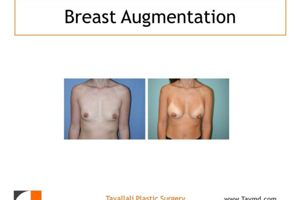Result of woman with small breast enlargement