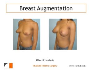 400 cc High profile breast enlargement