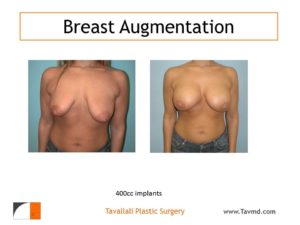 400 cc breast implant for enlargement in woman with droopy breasts