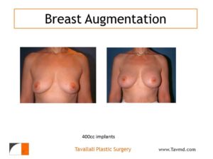 Woman with breast implants with 400 cc