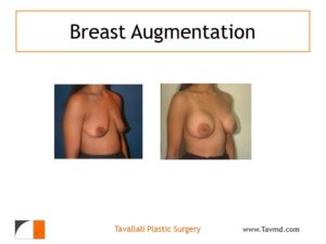 Result of woman with medium breast enlargement