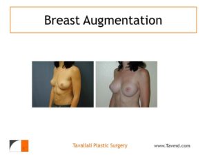 Before & after breast augmentation