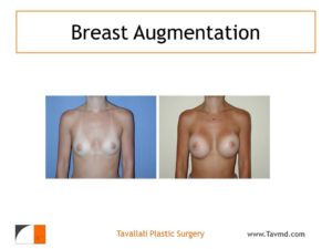 Before & after breast enlargement