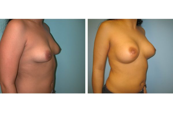 Breast augmentation surgery with implants