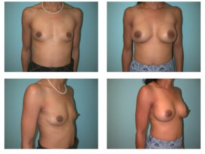 Breast surgery before after with implants