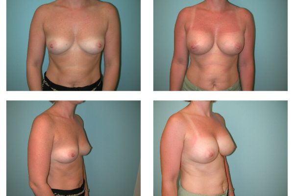 Breast implant enlargement before after surgery