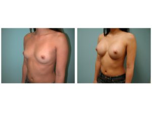 before after breast augmentation