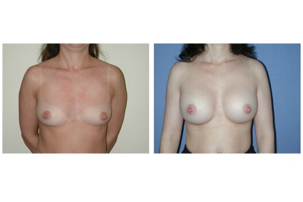 Before and after breast implant surgery with implants