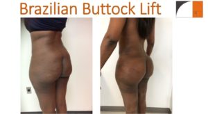 Brazilian buttock lift ,BBL, before & after photos Tavallali Plastic Surgery Northern VA