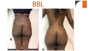 BBL Brazilian buttock lift liposuction abdomen and hips fat injection