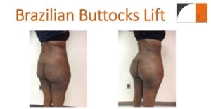BBL Brazilian buttock lift liposuction abdomen and hips fat injection before after