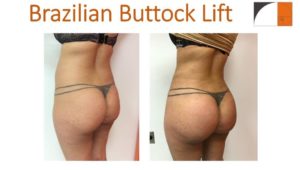 BBL Brazilian buttock lift with lipo of hips