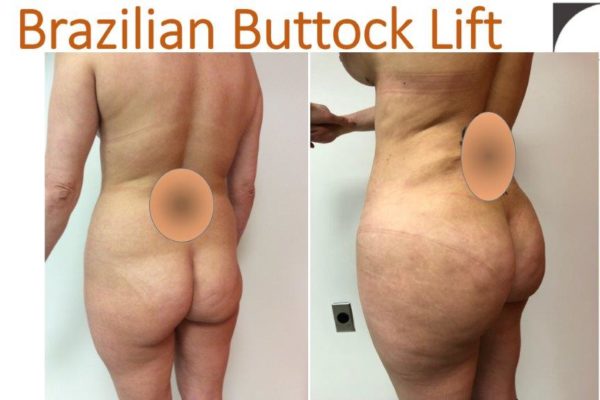 BBL Brazilian buttock lift liposuction hips fat injection before after