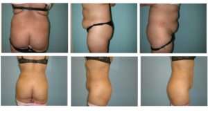 Multiple views liposuction and BBL Brazilian buttock lift