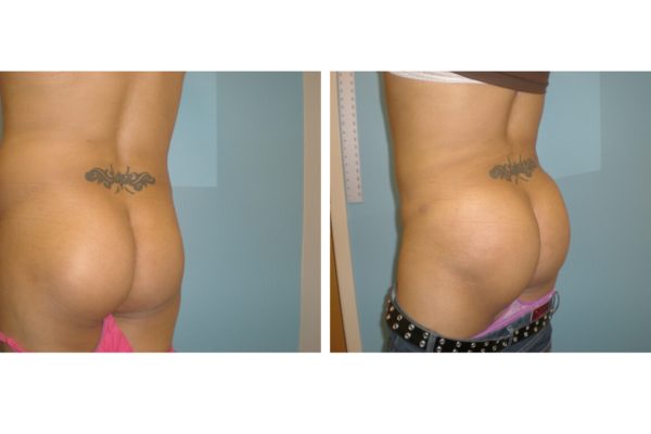 BBL Brazilian buttock lift enlargement of buttocks