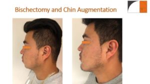 Bischectomy and Chin Surgery before after