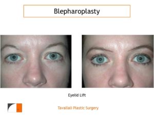 Young woman before after upper lid surgery
