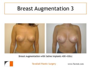 Breast augmentation with saline implants 400-430 cc