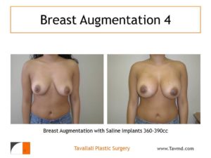 360-390cc implants for breast enlargement