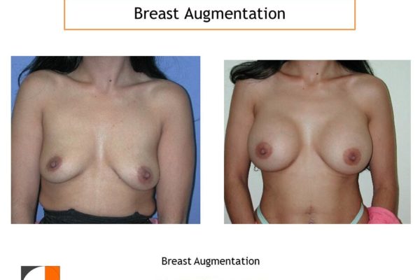 Breast augmentation before after virginia