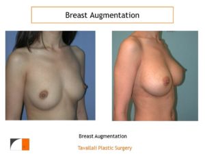 Breast enlargement before after