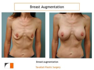 Breast augmentation over muscle with saline implant